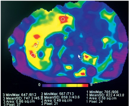 Imagen de elastoresonancia de h&iacute;gado donde se demuestra fibrosis
avanzada: 6.5 a 8.2 Kpa (colores amarillo y rojo en
la imagen).