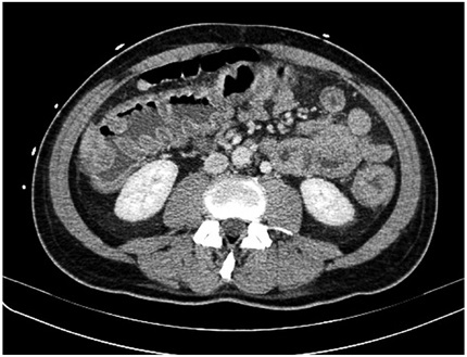 Tomografía de abdomen contrastado, en el que se observa engrosamiento de las paredes del marco cólico sin cambios inflamatorios pericolónicos, hallazgos que sugieren pancolitis.
