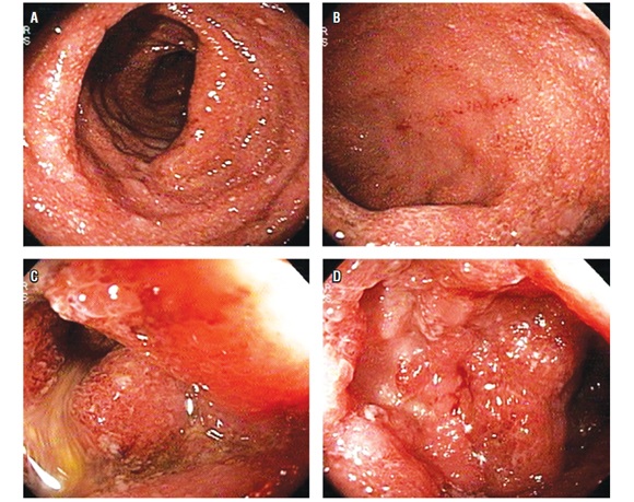 Colonoscopia. A y B. En el recto se observa compromiso total de la mucosa con pérdida del patrón vascular y ulceraciones pequeñas C y D. En colon sigmoide ulceraciones más grandes y profundas, compromiso grave de la mucosa.