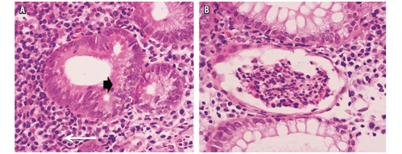 A. Histopatología en la que se observa pérdida de la arquitectura glandular (cabeza de flecha) notablemente con infiltrado inflamatorio linfoplasmocitario denso (flecha). B. Microabscesos críptico.