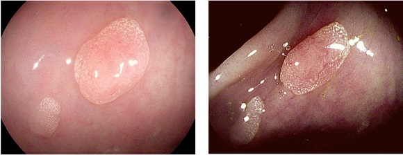 Caracterizaci&oacute;n de
p&oacute;lipos s&eacute;siles 0Is menores de 5 mm, de superficies p&aacute;lidas con criptas
redondas de tama&ntilde;o uniforme y vasos capilares aislados (no adenomatosos seg&uacute;n
clasificaci&oacute;n ICE); observados con luz blanca de alta definici&oacute;n y filtro de
cromoendoscopia virtual i-Scan 3, respectivamente.