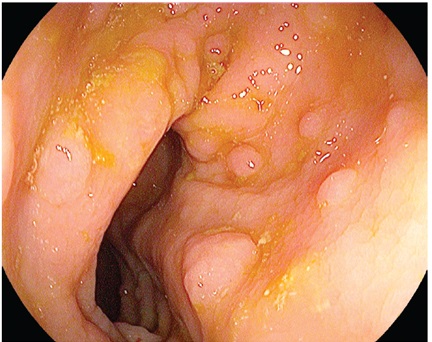 Varios p&oacute;lipos
diminutos en colon sigmoides observados con luz blanca de alta definici&oacute;n i-Scan, caracterizados seg&uacute;n clasificaci&oacute;n ICE como no
adenomatosos.