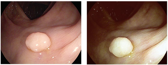 Caracterizaci&oacute;n
endosc&oacute;pica de p&oacute;lipo s&eacute;sil menor de 5 mm, patr&oacute;n de criptas redondas de igual
tama&ntilde;o observadas con luz blanca de alta definici&oacute;n y luego con i-Scan 2. Clasificado seg&uacute;n ICE no adenomatoso.