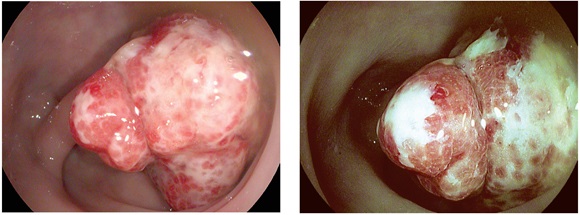 Caracterizaci&oacute;n de
p&oacute;lipo pediculado de 0Ip de 15 mm, de caracter&iacute;sticas adenomatoso con fosos
ovalados y tubulares seg&uacute;n clasificaci&oacute;n ICE, observados con cromoendoscopia
virtual i-Scan 1 y 2, respectivamente.