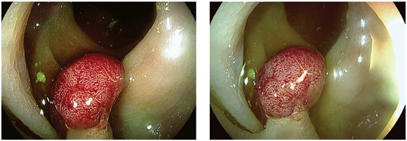 Caracterizaci&oacute;n de
p&oacute;lipo pediculado 0Ip de 10 mm, de color rojizo, observado con cromoendoscopia
virtual i-Scan 2 y 3, respectivamente. Adenomatoso
seg&uacute;n clasificaci&oacute;n ICE.