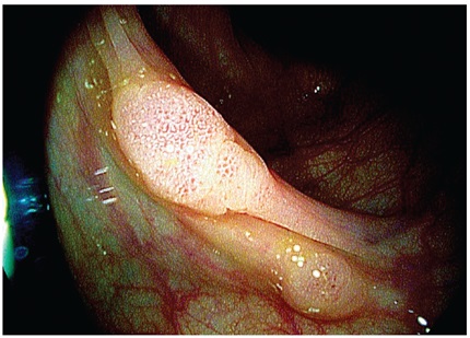 Caracterizaci&oacute;n de
p&oacute;lipo s&eacute;sil menor de 5 mm, 0Is con criptas ovales y tubulares, patr&oacute;n de vasos
capilares dilatados, observado con cromoendoscopia virtual i-Scan 2, clasificaci&oacute;n ICE adenomatoso.