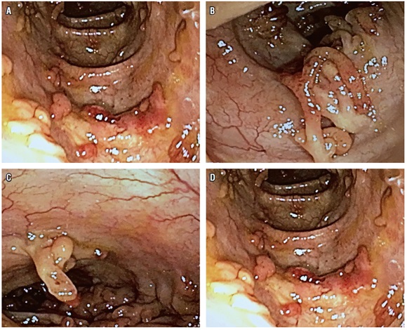 P&oacute;lipos postinflamatorios