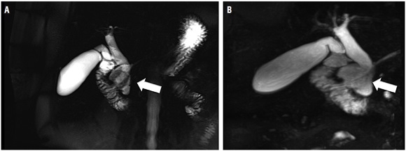 Colangiorresonancia A-B.
Se indica la presencia de divert&iacute;culo duodenal.