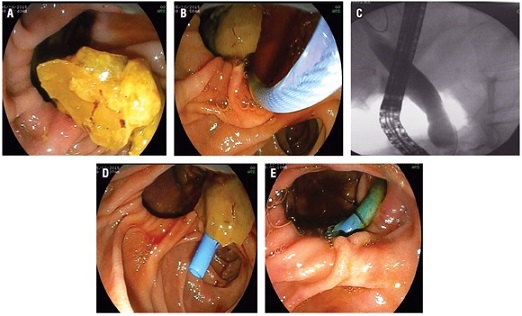 A. Imagen endosc&oacute;pica del divert&iacute;culo duodenal. B. Canulaci&oacute;n de la papila intradiverticular.
C.
Colangiograf&iacute;a. D. Stent ulterior a CPRE. E. CPRE de control para el retiro del stent.