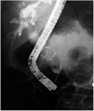 C&aacute;lculo biliar gigante.