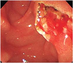 Esfinterotom&iacute;a mediana.