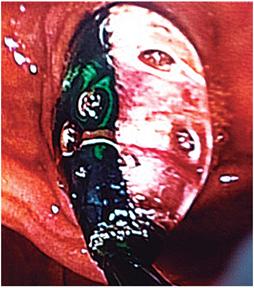 Dilataci&oacute;n papilar con bal&oacute;n grande (DPBG).