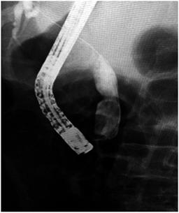 Dilataci&oacute;n (cintura del bal&oacute;n)