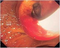 Orificio papilar posdilataci&oacute;n.