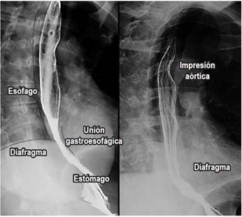 Esofagograma normal. En las imágenes, se encuentran las diferentes estructuras de importancia (impresión aórtica, diafragma derecho e izquierdo, unión esofagogástrica y estómago). Pared esofágica de mucosa lisa sin irregularidades.