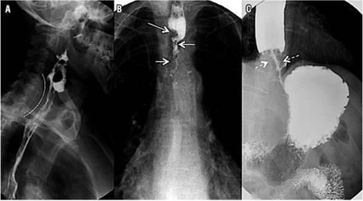 Tumores malignos del esófago. A. Se observa un tumor maligno que compromete el esófago cervical en su aspecto posterior (línea punteada), y existe tránsito lento del bario e irregularidad en la superficie mucosa. B. Se observa un tumor maligno que compromete el esófago torácico, y existe paso filiforme del medio de contraste (flechas blancas) por el adelgazamiento tumoral, que tiene un patrón de crecimiento concéntrico. C. Se observa un tumor maligno del esófago distal y se evidencia crecimiento concéntrico del tumor (flechas blancas punteadas) y paso filiforme del bario, con tránsito lento de este y distensión esofágica proximal.