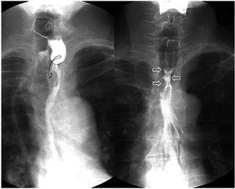 Evaluación de los procedimientos quirúrgicos. Anastomosis esofagogástrica intratorácica laterolateral (izquierda). Se observa un adecuado paso del medio de contraste (flecha curva). También se observa estenosis posquirúrgica (derecha) en un paciente con antecedente de esofagectomía, con un área de estrechez en el sitio de la anastomosis (flechas blancas) y adelgazamiento de la luz esofágica.