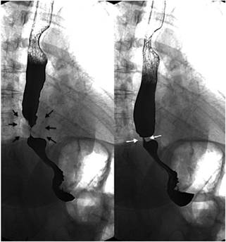 Fundoplicatura de Nissen. Se observa la presencia del wrap rodeando completamente la unión esofagogástrica (flechas negras), lo que permite el adecuado paso del medio de contraste (flechas blancas).