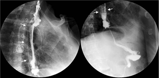 Prótesis (stent) a nivel del esófago medio por cáncer estenosante. En las dos imágenes (izquierda y derecha), las flechas blancas marcan la extensión de la prótesis y, en su interior, se observa el paso del medio de contraste.