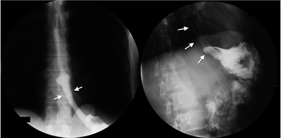 Prótesis (stent) a nivel de la unión esofagogástrica. En las dos imágenes (izquierda y derecha), las flechas blancas marcan la extensión del stent y, en su interior, se observa el paso del medio de contraste hacia el estómago.