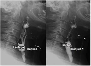 Aspiración. Proyecciones laterales de un esofagograma. Aspiración del medio de contraste dado por el paso filiforme del medio de contraste (flechas blancas) desde el esófago, en sentido anterior hacia la vía aérea.