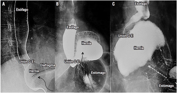 Hernia hiatal. A. Se encuentra una hernia hiatal por deslizamiento (de tipo I) y se observa el “deslizamiento” de la unión esofagogástrica por encima del nivel diafragmático (demarcado con una línea negra). B. Se observa una hernia paraesofágica (de tipo II) en la que se encuentra un desplazamiento del fondo y parte del cuerpo gástrico (flecha negra), pero permanece la unión gástrica en su posición normal. C. Se observa una hernia hiatal mixta (de tipo III) con desplazamiento de la unión esofagogástrica y del fondo gástrico hacia el tórax (flecha blanca). La hernia hiatal de tipo IV contiene órganos diferentes al estómago, difíciles de valorar en este estudio.