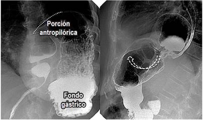 Vólvulo gástrico. En la primera imagen, se observa un vólvulo gástrico mesenterioaxial (derecha) en el que la rotación gástrica sobre el eje del mesenterio; el antro se mueve hacia la parte superior (línea punteada), y el fondo queda en posición inferior. En la segunda imagen, se observa un vólvulo gástrico organoaxial (izquierda) en el que existe rotación y desplazamiento de las partes gástricas (flecha blanca punteada).