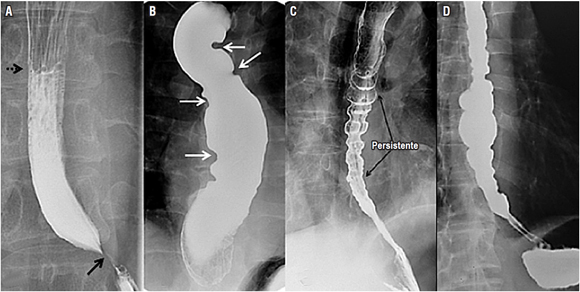 Trastornos de la motilidad esofágica. A. Se observa la imagen clásica de la acalasia: nivel hidroaéreo en el tercio medio esofágico (flecha punteada), estrechamiento esofágico distal que configura el signo de “pico de pájaro” (flecha negra), dilatación esofágica y ausencia de peristalsis (bordes esofágicos rectos o lisos). B. Se observa un estadio terminal de la acalasia (esófago sigmoideo), con múltiples curvas que no permiten el adecuado tránsito del bario por el esófago. C. Se encuentra un esofagograma característico del espasmo esofágico difuso, con múltiples áreas de contracción esofágica descoordinadas. D. Se observa un esófago en cascanueces.