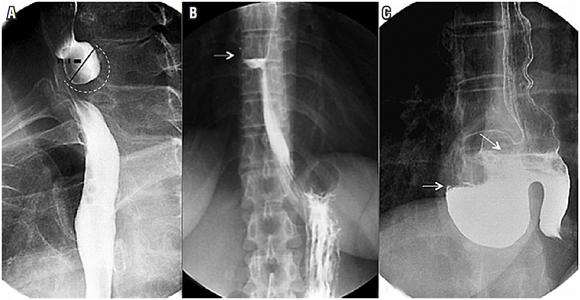 Divertículos esofágicos. A. Se observa un divertículo de Zenker y se identifica un saco diverticular (línea curva punteada) en la cara posterior del tercio superior del esófago que se opacifica con el medio de contraste. B. Se encuentra un divertículo del esófago medio, un saco diverticular de base ancha situado en el tercio medio del esófago y se observa un nivel hidroaéreo (flecha blanca) por opacificación parcial con el medio de contraste. C. Se observa un divertículo epifrénico, un saco diverticular localizado en el esófago distal y, en su interior, se encuentran niveles hidroaéreos por llenado parcial con el medio de contraste.
