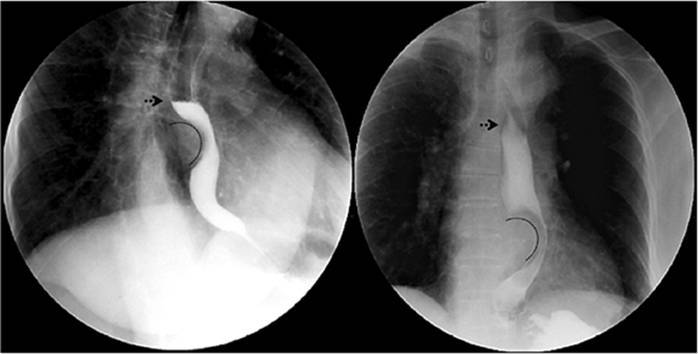 Disfagia cardiovascular. Esofagograma en proyecciones oblicua lateral (izquierda) y anteroposterior (derecha) en las que se identifica crecimiento auricular izquierdo (línea curva) que impronta y desplaza el esófago hacia la izquierda con nivel hidroaéreo (flecha punteada) por tránsito lento.
