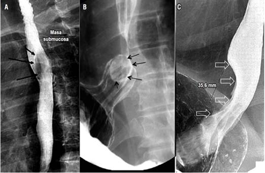 Tumores benignos del esófago. A. Se observa un quiste de duplicación esofágico y una lesión que genera compresión extrínseca del tercio medio del esófago en su pared posterior (flechas negras). B. Se encuentra la imagen correspondiente a un pólipo fibrovascular esofágico, en la que se observa una lesión redondeada intraluminal en el tercio distal del esófago. C. Se encuentra la imagen correspondiente a un leiomioma, en la que se observa compresión y adelgazamiento de la luz esofágica por una lesión fusiforme en el tercio distal del esófago.