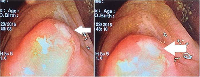 Orificio apendicular prominente (flechas blancas), con drenaje de material purulento hacia la luz del colon.