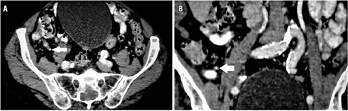 Tomograf&iacute;a computarizada que muestra un fecalito en la luz del ap&eacute;ndice (flecha blanca). A. Corte transversal. B. Corte coronal.