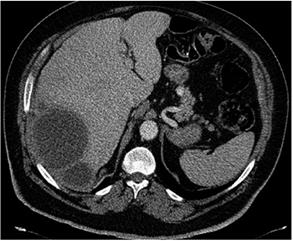 Tomograf&iacute;a computarizada contrastada de abdomen en la que se observa una colecci&oacute;n septada subhep&aacute;tica posterior derecha.