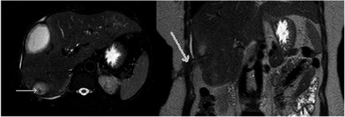 A. RM de abdomen con secuencia axial potenciada en T2 con supresi&oacute;n grasa DRIVE, en la cual se observan colecciones perihep&aacute;ticas con presencia de un vac&iacute;o de se&ntilde;al en el interior (flecha) correspondiente a un c&aacute;lculo abandonado. B. Imagen coronal de RM potenciada en T2, en la cual se observa un trayecto fistuloso a la piel (flecha) en paciente con antecedente de CLP con c&aacute;lculo abandonado en cavidad abdominal.