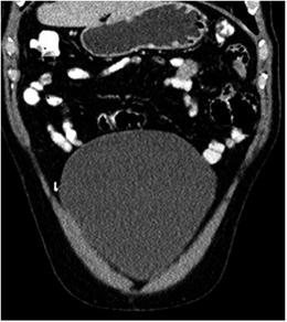 Reconstrucci&oacute;n coronal de tomograf&iacute;a computarizada contrastada de abdomen. Se observa un clip met&aacute;lico libre despu&eacute;s de una colecistectom&iacute;a laparosc&oacute;pica. N&oacute;tese la ausencia de reacci&oacute;n inflamatoria al rededor del clip (flecha).