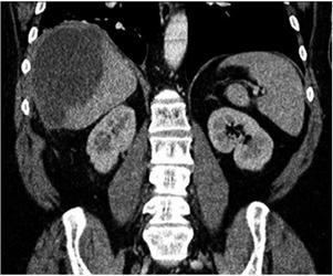 Reconstrucci&oacute;n coronal de una TC abdominal en la cual se observa colecci&oacute;n subfr&eacute;nica derecha secundaria a reacci&oacute;n a c&aacute;lculos abandonados 4 meses despu&eacute;s de una colecistectom&iacute;a por laparoscopia en un paciente con piocolecisto.