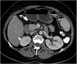 TC abdominal contrastada en corte axial. Se observan calcificaciones en espacio hepatorrenal, las cuales corresponden a c&aacute;lculos abandonados despu&eacute;s de una colecistectom&iacute;a por laparoscopia sin reacci&oacute;n a un cuerpo extra&ntilde;o.