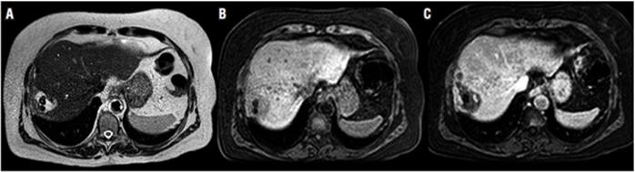A. RM potenciada en T2 axial. Se identifica colecci&oacute;n subhep&aacute;tica con 2 defectos hipointensos en su interior (*), los cuales corresponden a c&aacute;lculos abandonados. B. RM potenciada en T1 axial. Se identifica colecci&oacute;n subhep&aacute;tica con 2 defectos hipointensos en su interior (*), los cuales corresponden a c&aacute;lculos abandonados. C. Imagen axial de RM contrastada en secuencia T1 en la cual se observa realce perif&eacute;rico de la colecci&oacute;n perihep&aacute;tica derecha secundaria a c&aacute;lculos abandonados.
