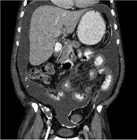 Reconstrucci&oacute;n coronal de tomograf&iacute;a computarizada de abdomen en un paciente con diagn&oacute;stico de peritonitis retr&aacute;ctil por di&aacute;lisis. N&oacute;tese la presencia de m&uacute;ltiples calcificaciones irregulares sobre los repliegues peritoneales, las cuales no deben confundirse con litos.