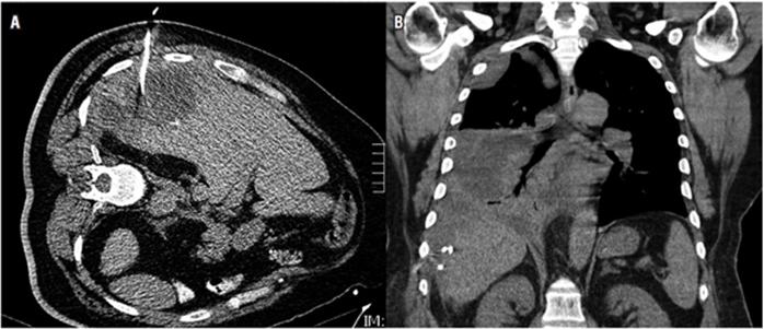 A. Imagen de tomograf&iacute;a computarizada abdominal simple como gu&iacute;a para drenaje percut&aacute;neo de colecci&oacute;n subhep&aacute;tica derecha. B. Reconstrucci&oacute;n coronal de TC de t&oacute;rax del mismo paciente, en la que se observa colecci&oacute;n pleural tabicada por drenaje a t&oacute;rax de la colecci&oacute;n despu&eacute;s de 24 horas del manejo percut&aacute;neo. Obs&eacute;rvese el extremo del cat&eacute;ter pigtail (*).