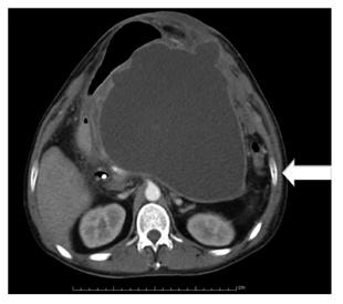 TAC de abdomen con contraste. Pseudoquiste pancre&aacute;tico. La flecha se&ntilde;ala el pseudoquiste pancre&aacute;tico. 