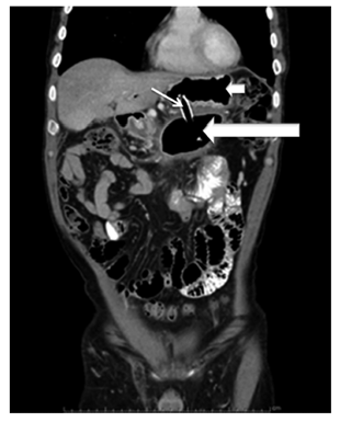 TAC de abdomen con contraste, control 1 semana (seguimiento al paciente de la Figura 1). Pseudoquiste pancre&aacute;tico con drenaje transmural. La flecha corta se&ntilde;ala la cavidad g&aacute;strica, la flecha delgada se&ntilde;ala el stent comunicando la cavidad g&aacute;strica y pancre&aacute;tica y la flecha larga se&ntilde;ala la cavidad del pseudoquiste pancre&aacute;tico. 