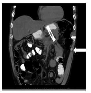 TAC de abdomen con contraste, control a las 6 semanas (seguimiento paciente de la Figura 1). Pseudoquiste pancre&aacute;tico con drenaje transmural. La flecha corta se&ntilde;ala la cavidad g&aacute;strica en la que se observa medio de contraste y la flecha larga se&ntilde;ala el pseudoquiste pancre&aacute;tico drenado. 