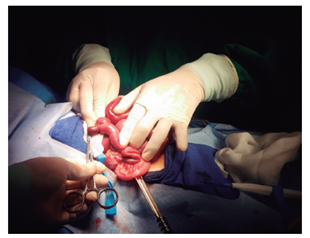 Divert&iacute;culo de Meckel con brida en extremo distal que lo un&iacute;a al mesenterio creando un anillo herniario en cuyo interior se encontr&oacute; el &iacute;leon distal. 