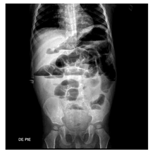Radiograf&iacute;a anteroposterior (AP) de abdomen. Se observa dilataci&oacute;n de asas intestinales y algunos niveles hidroa&eacute;reos. 