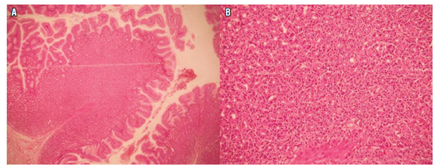 Histopatolog&iacute;a del divert&iacute;culo de Meckel. A: mucosa g&aacute;strica corporal ect&oacute;pica. B: con mayor aumento se observan c&eacute;lulas parietales (tinci&oacute;n hematoxilina eosina). 