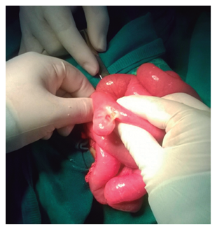 Divert&iacute;culo de Meckel perforado formando un plastr&oacute;n que provoca obstrucci&oacute;n intestinal. 