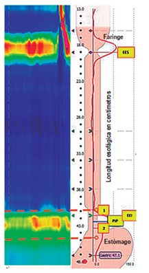 Puntos de referencia del software de MAR. Es necesaria la correcta colocaci&oacute;n de los puntos de referencia en el software para lograr un an&aacute;lisis correcto de presiones basales y evaluaci&oacute;n de las degluciones. 1: borde superior del EEI; 2: borde inferior del EEI. Los puntos naranjas seguidos por las l&iacute;neas punteadas delimitan el e-Sleeve para el an&aacute;lisis de la presi&oacute;n residual en la UGE durante las degluciones, por tanto, su ubicaci&oacute;n debe abarcar toda la UGE.