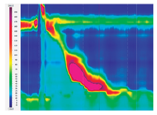 Es&oacute;fago hipercontr&aacute;ctil (jackhammer). Se define por degluciones hipercontr&aacute;ctiles (DCI >8000 mm Hg/s/cm).